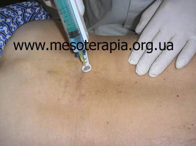 мезотерапія у лікуванні больових синдромів