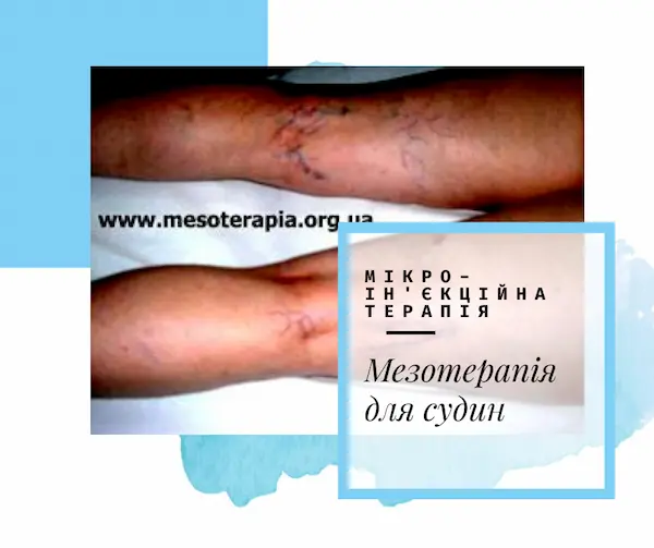 мезотерапія для судин
