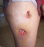 осложнения при лечении целлюлита фосфатидилхолином