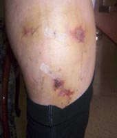 осложнения при лечении целлюлита